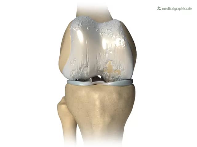 Knie frontal mit folgenden Strukturen: Oberschenkelknochen, Wadenbein, Schienenbein. teilweise regenerierter Gelenkknorpel, zurückgebildete Entzündung des Gelenks